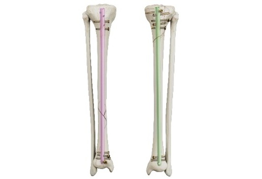 Image: The TRIGEN MAX tibia nailing system offers stability and reduces post-operative soft tissue irritation (Photo courtesy of Smith+Nephew)